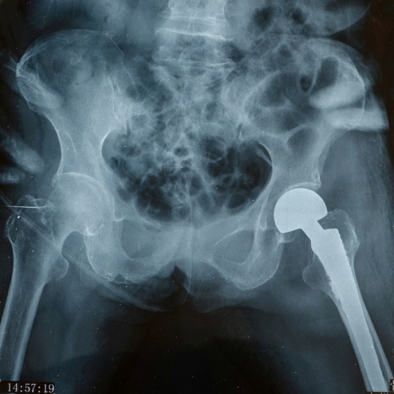 …. ob der Patienten eine Hüftprothese (hier im Röntgenbild) oder … (Bild: Envato)